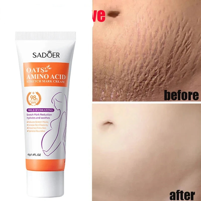 Stretch Mark Removal Cream – Repair, Firm & Smooth Skin