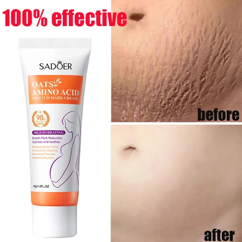 Stretch Mark Removal Cream – Repair, Firm & Smooth Skin