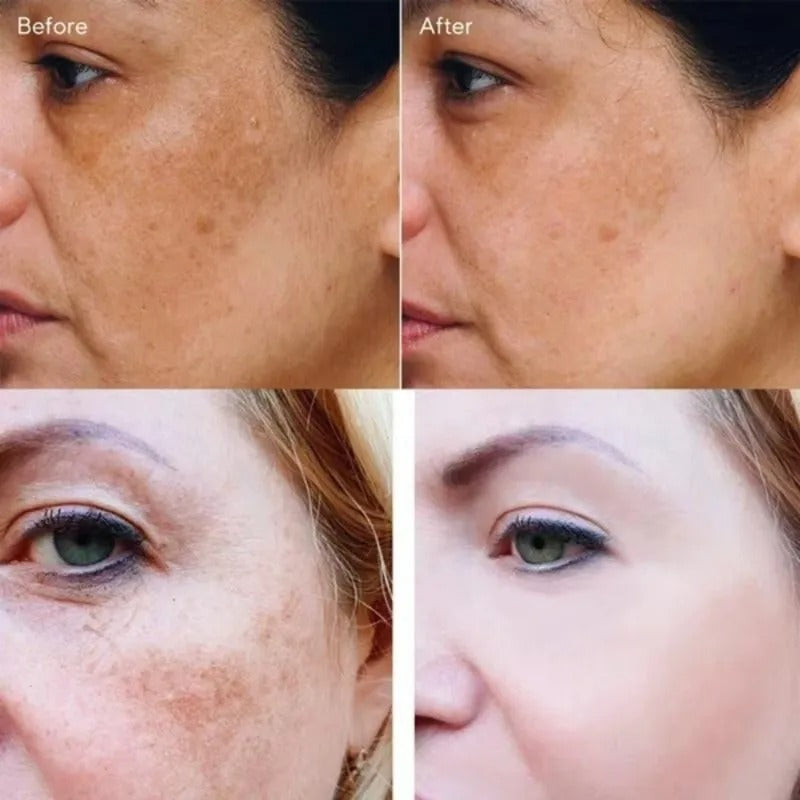 Dark Spot Remover Whitening Serum – Anti-Pigmentation & Brightening