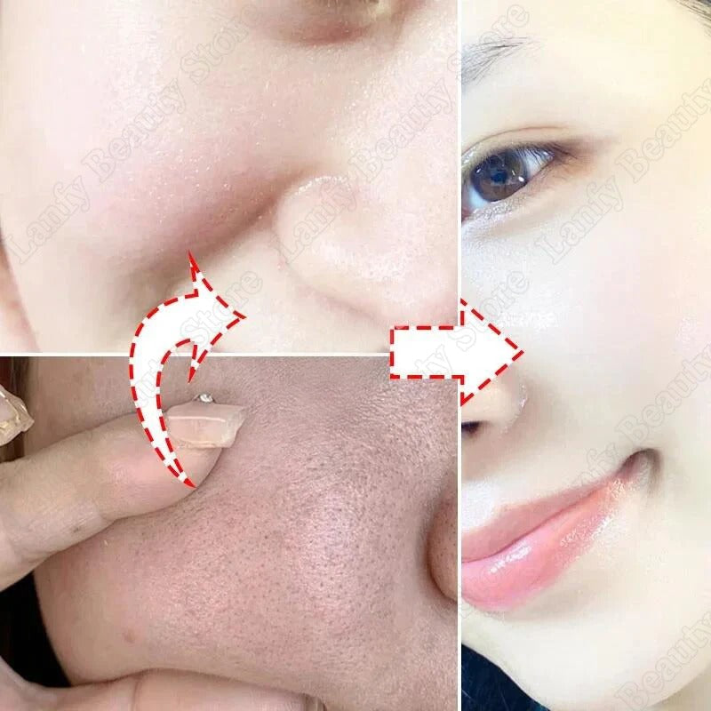 Salicylic Acid Pore Clearing Cream – Blackhead & Acne Removal Moisturizer
