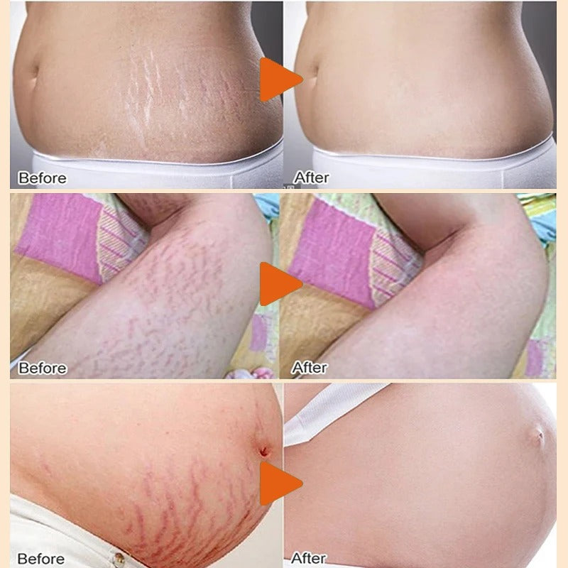Stretch Mark Removal Cream – Repair, Firm & Smooth Skin