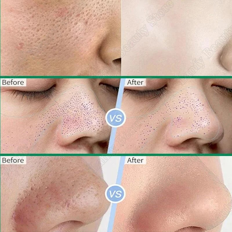 Salicylic Acid Pore Clearing Cream – Blackhead & Acne Removal Moisturizer