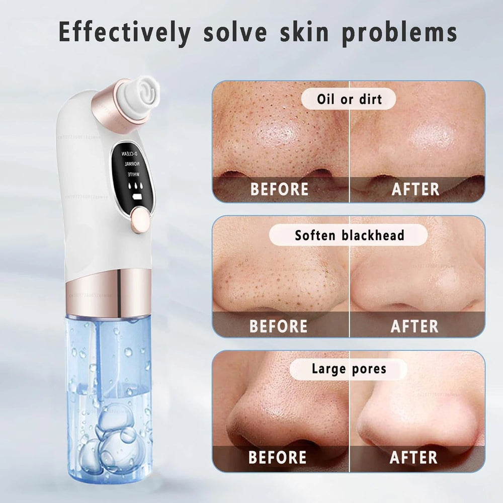 Electric Blackhead Remover Vacuum with Water Cycle System