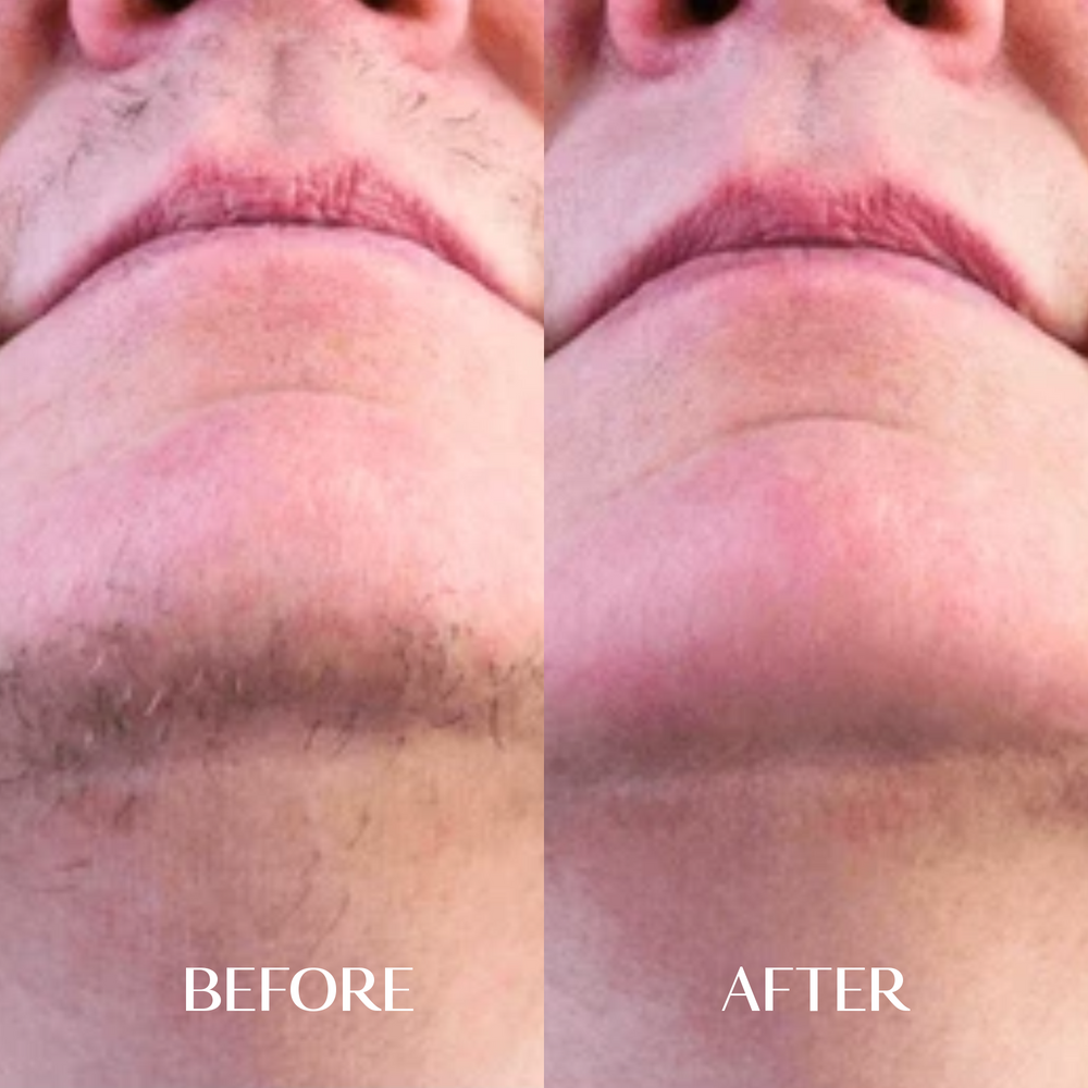 The Facial Hair Serum | 1+1 FREE