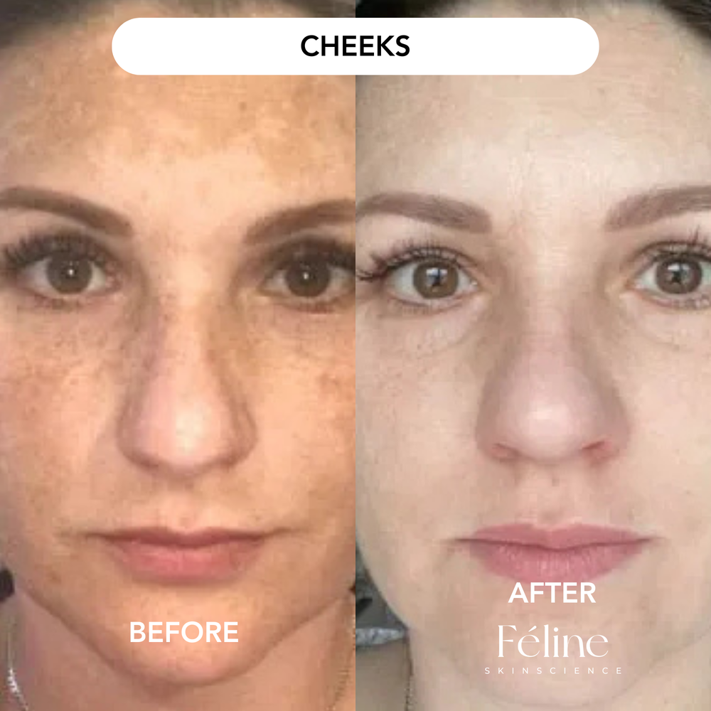 Melasma Corrector | 1+1 FREE