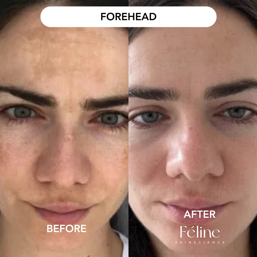 Melasma Corrector | 1+1 FREE