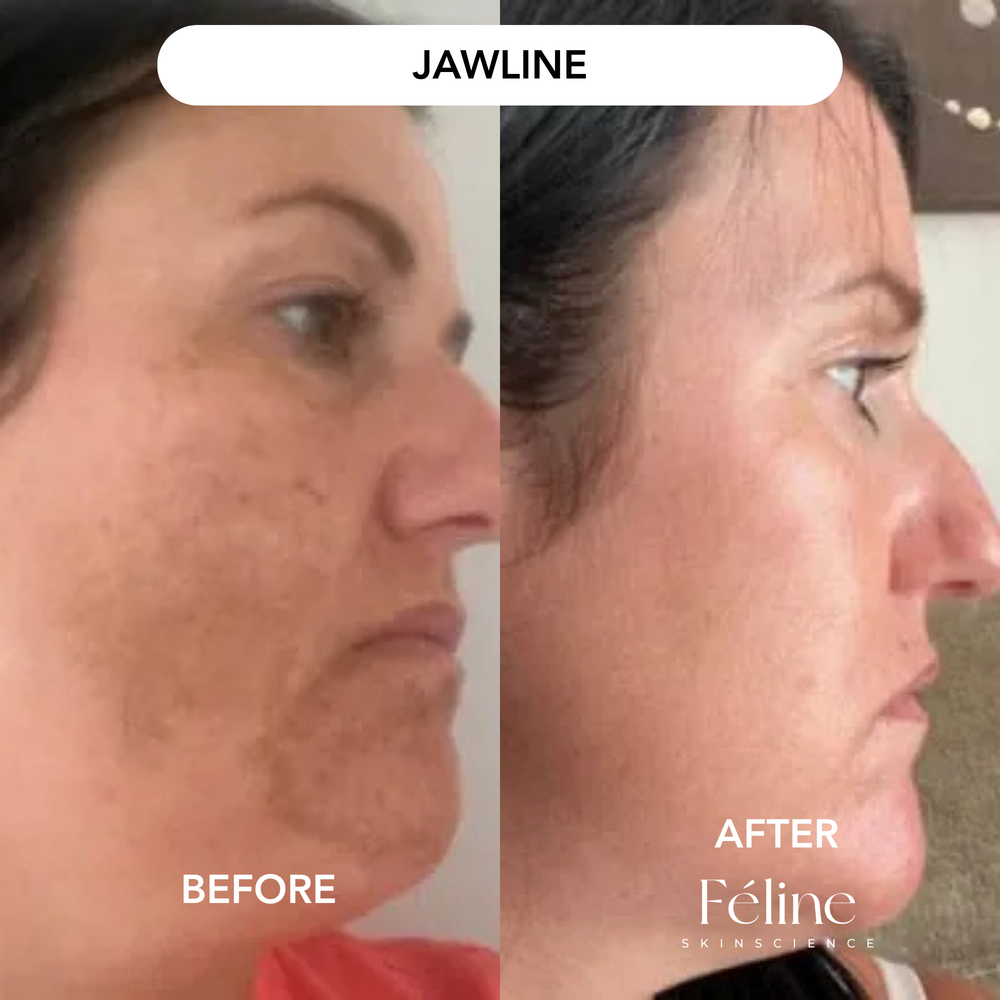 Melasma Corrector | 1+1 FREE
