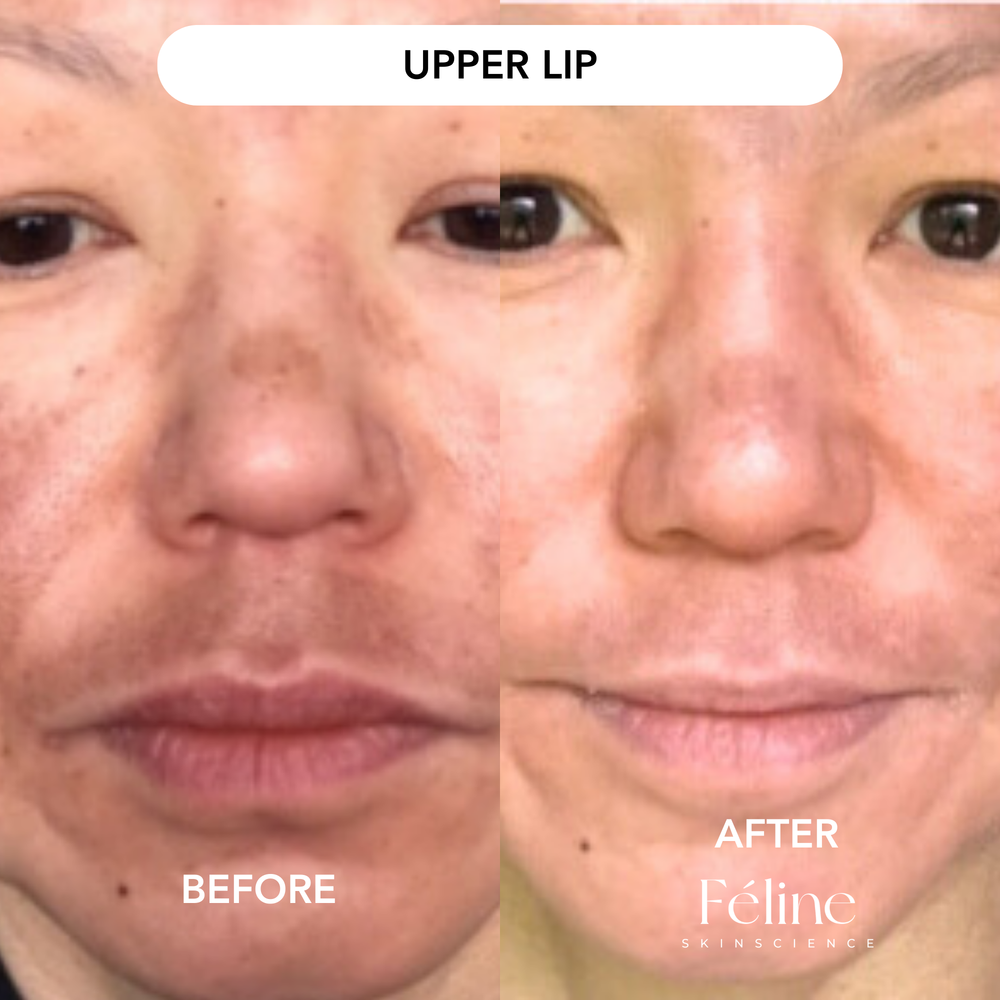 Melasma Corrector | 1+1 FREE