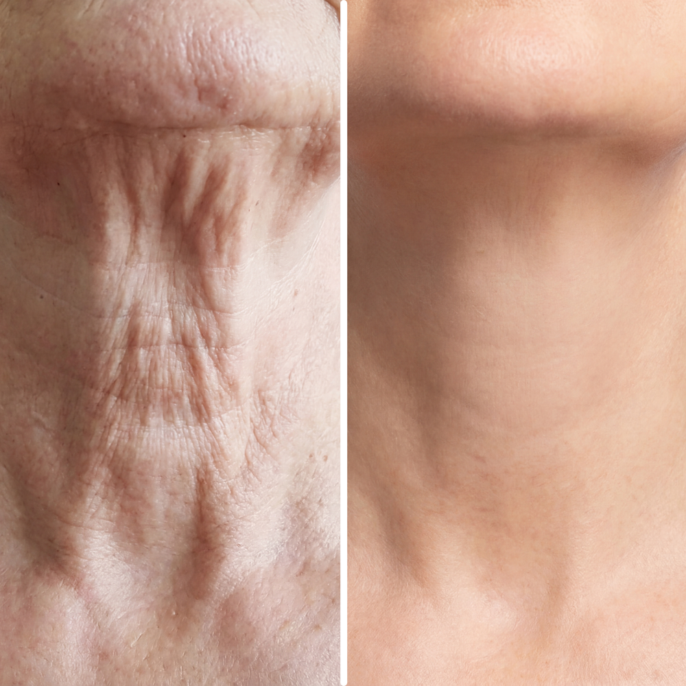 Advanced  Neck Crepe Fix | 1+1 FREE