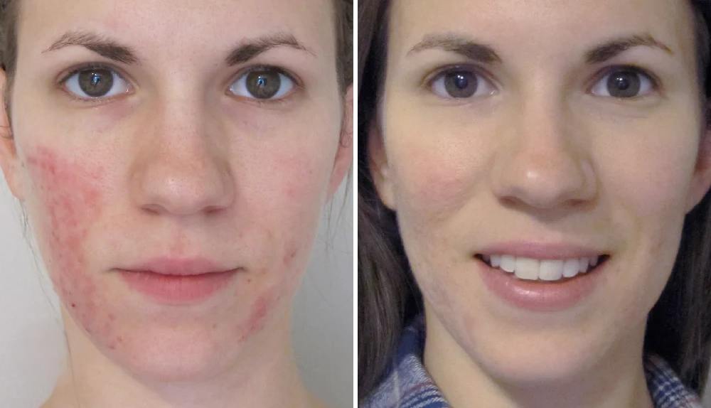 1 x Rosacea Corrector