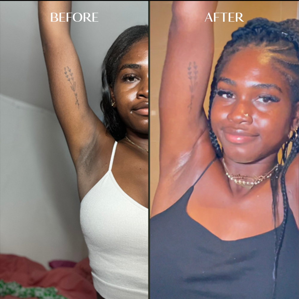 Melanin Dark Spot Corrector | 1+1 FREE