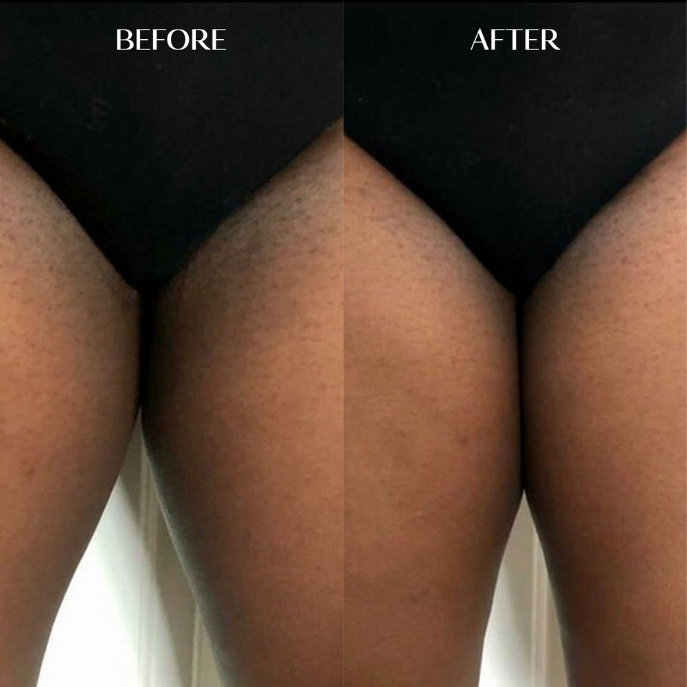 Melanin Dark Spot Corrector | 1+1 FREE