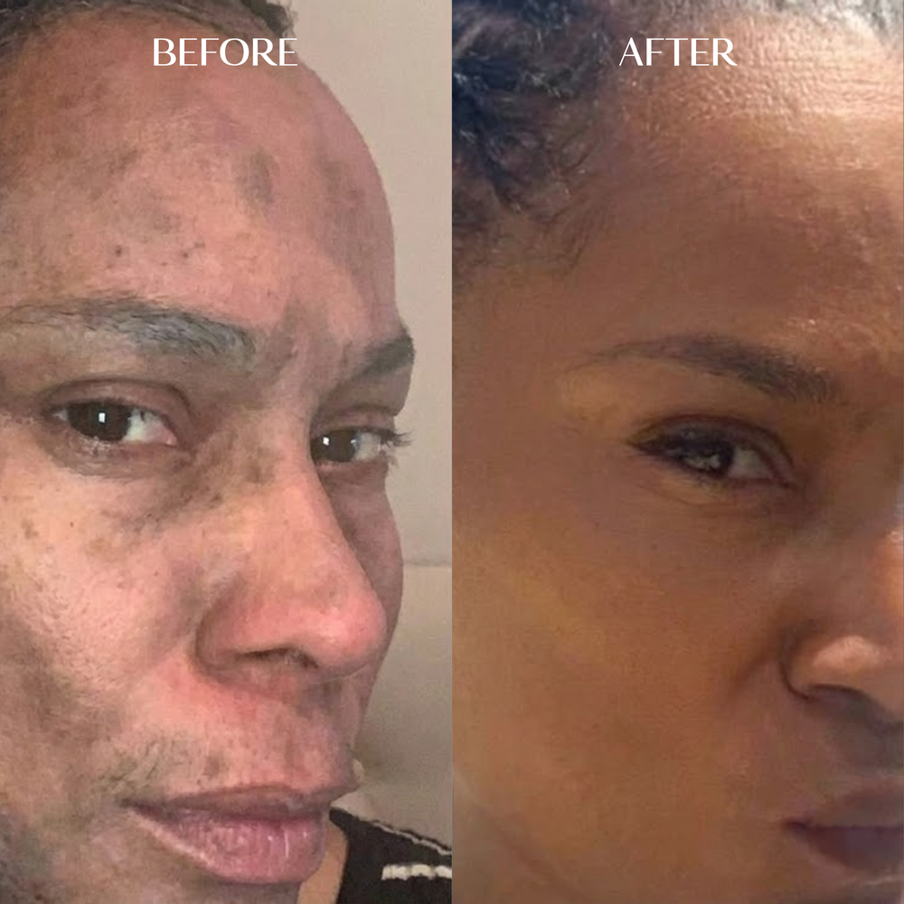 Melanin Dark Spot Corrector | 1+1 FREE