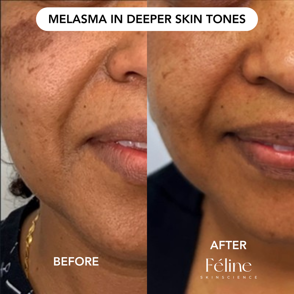 Melasma Corrector | 1+1 FREE