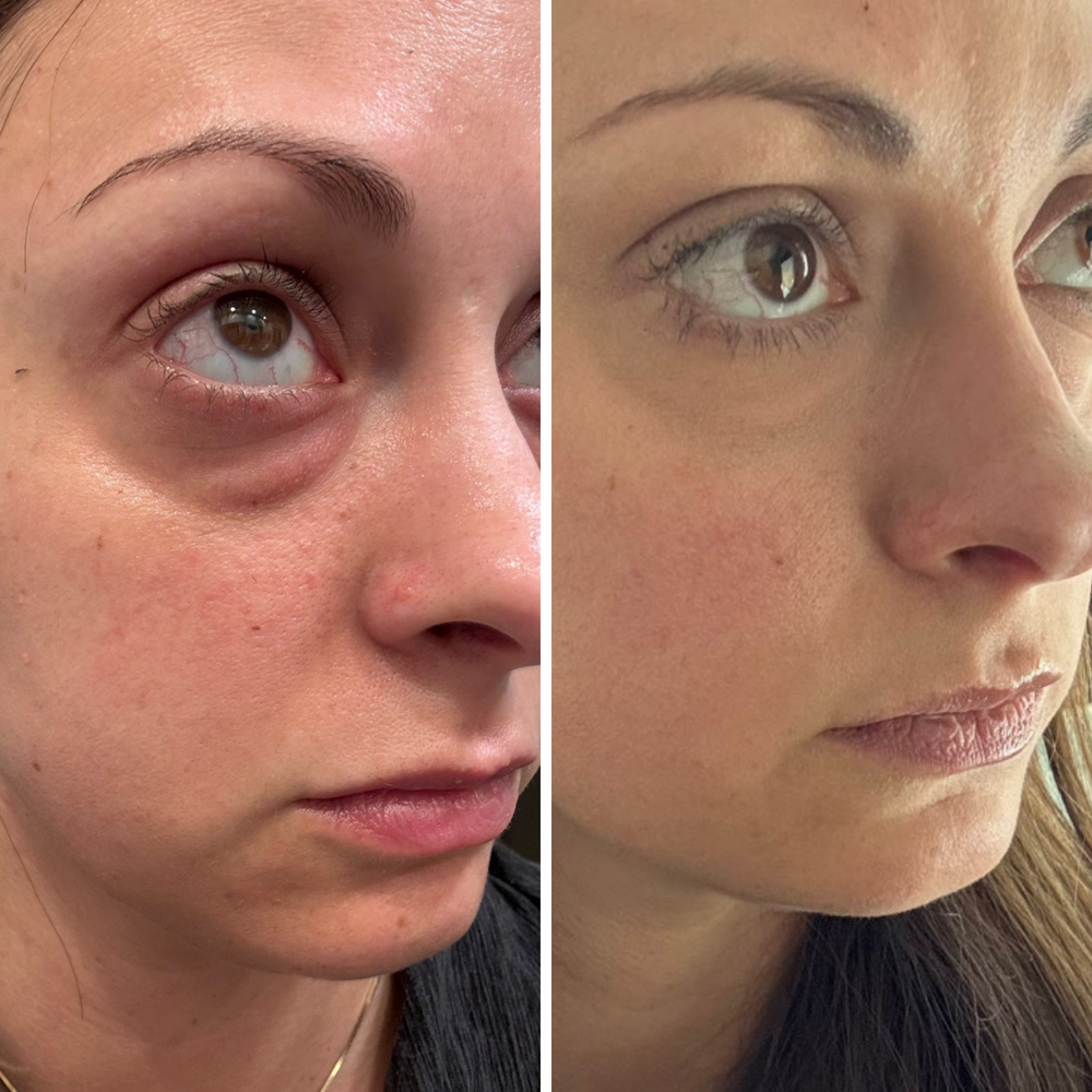 Dark Circle Corrector | 1+1 FREE