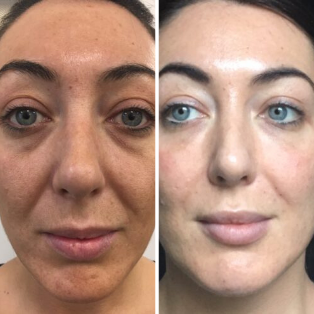 Dark Circle Corrector | 1+1 FREE