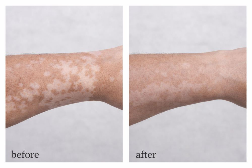 Vitiligo Corrector