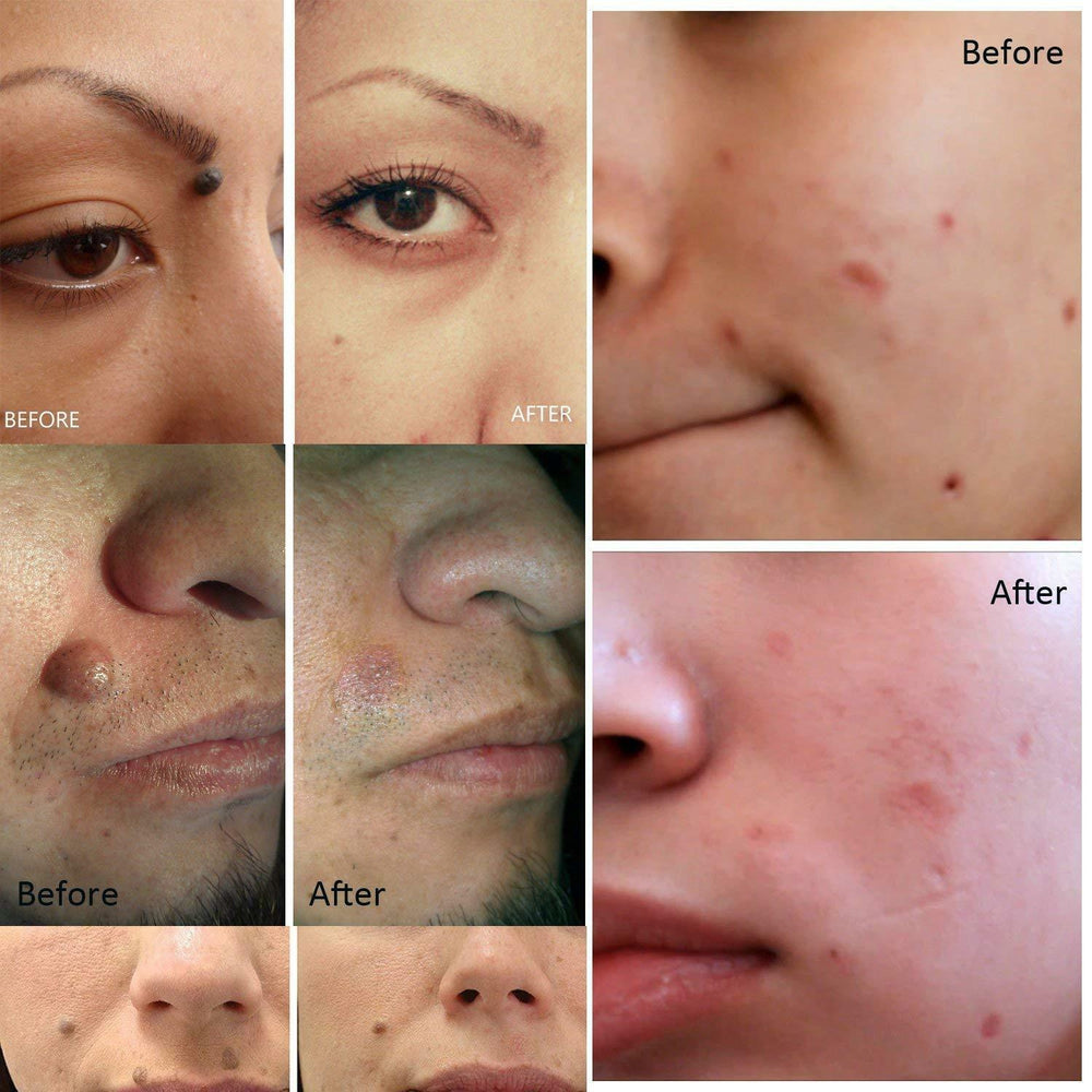 ElysiumGlow | Efficient Portable Skin Blemish Removal Pen