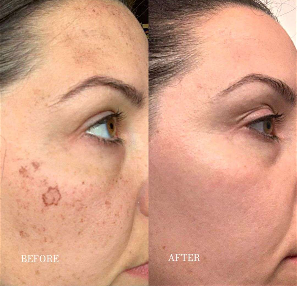 Dark Spot Corrector | 1+1 FREE