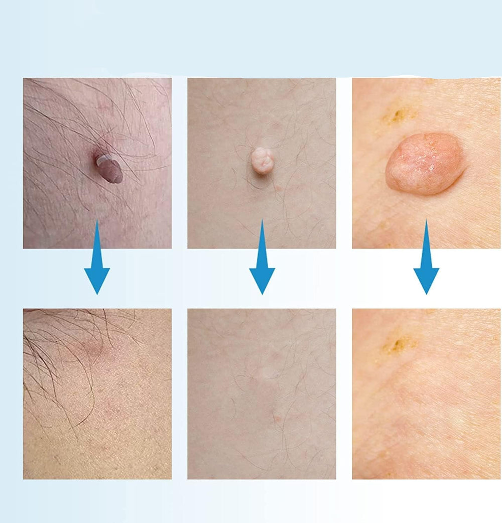 Skin Tag & Mole Remover Kit for Painless Treatment at Home