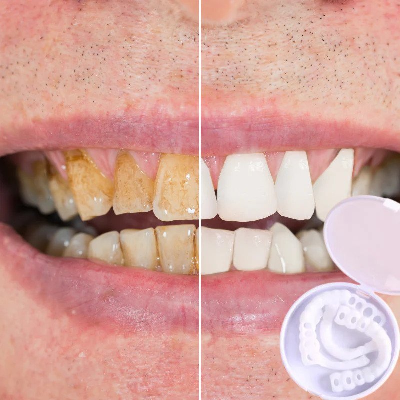 SmileSnap | Perfect Veneer Snap-On Teeth for a Confident Smile