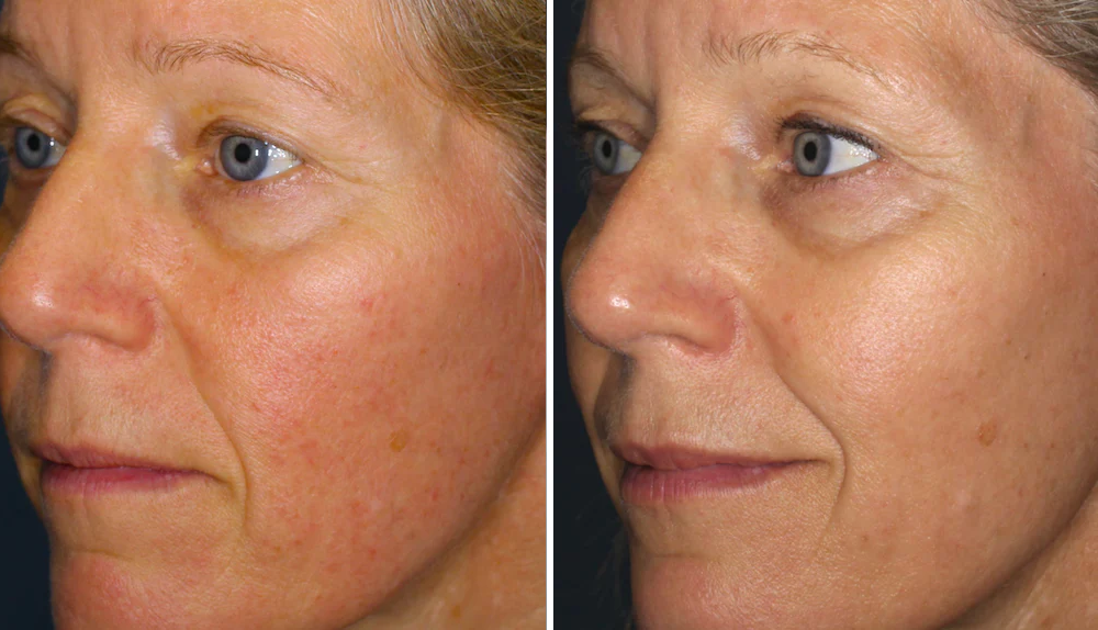 1 x Rosacea Corrector