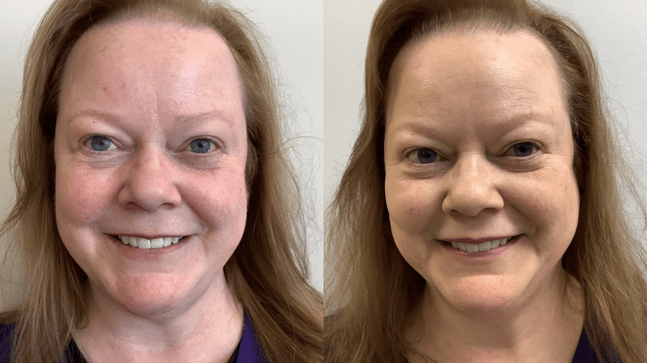 1 x Rosacea Corrector