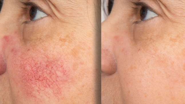 1 x Rosacea Corrector