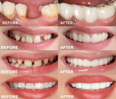 BrightBite - EasyClick Denture Prosthesis