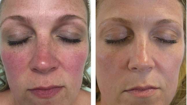 1 x Rosacea Corrector