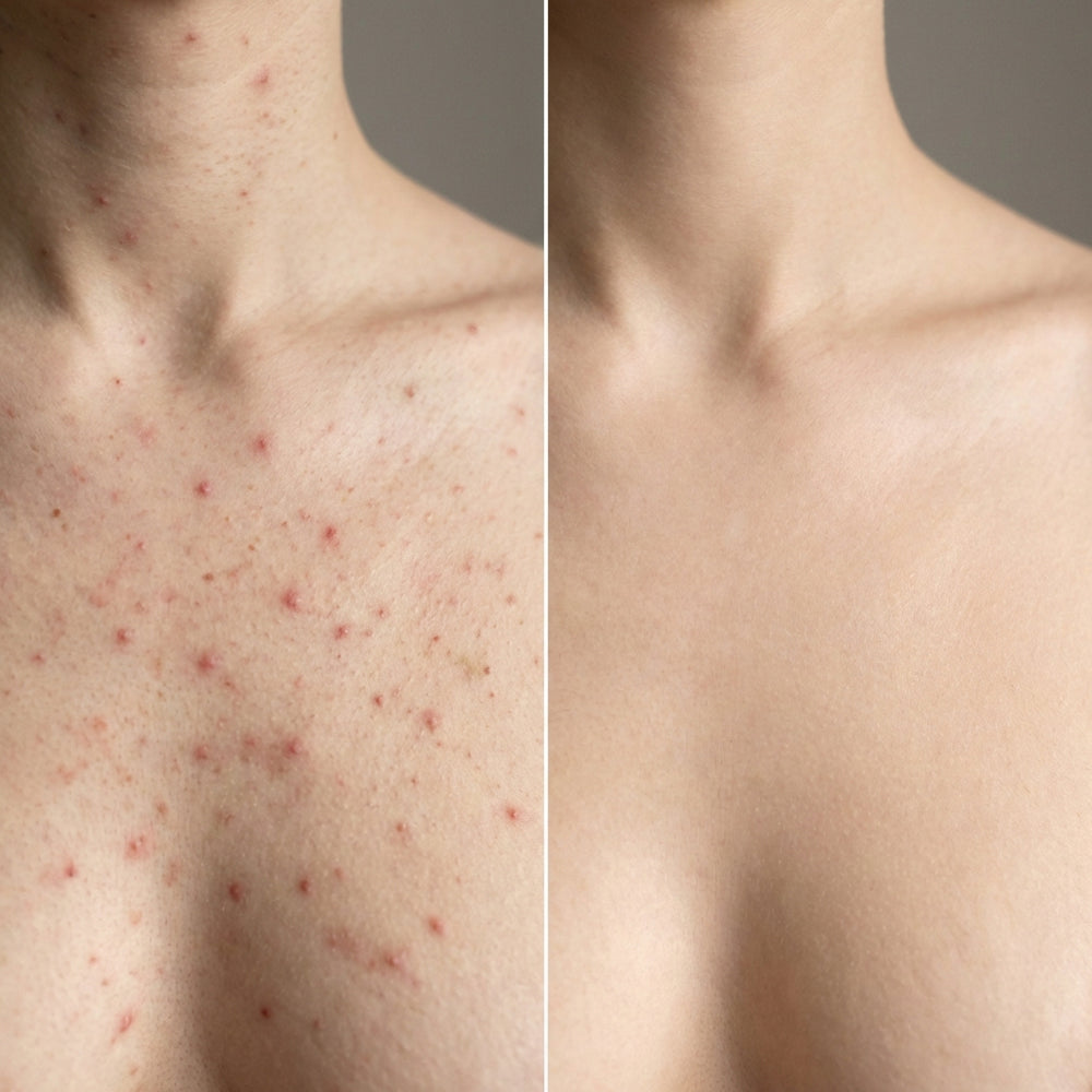 Post Acne Mark Corrector | 1+1 FREE