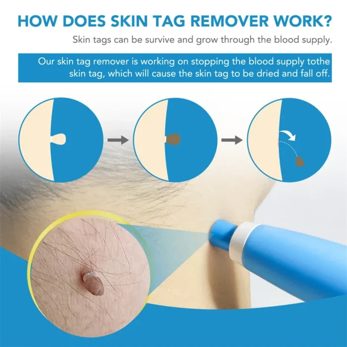 Skin Tag & Mole Remover Kit for Painless Treatment at Home
