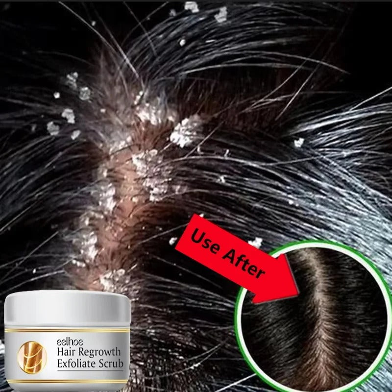 Anti-Dandruff Exfoliating Scalp Scrub – Anti-Itch & Oil Control Treatment