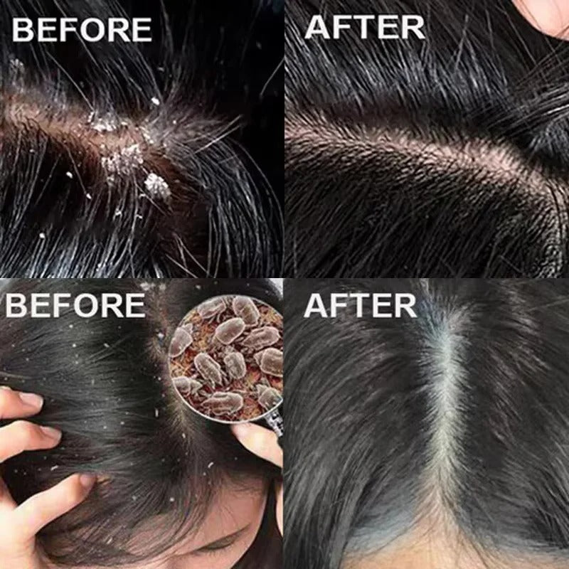 Anti-Dandruff Exfoliating Scalp Scrub – Anti-Itch & Oil Control Treatment