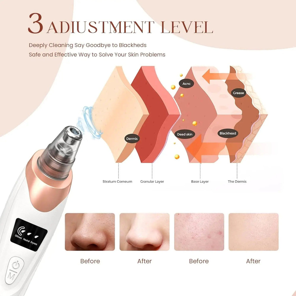 Blackhead Remover Vacuum Pore Cleaner – Electric Acne Extractor Tool