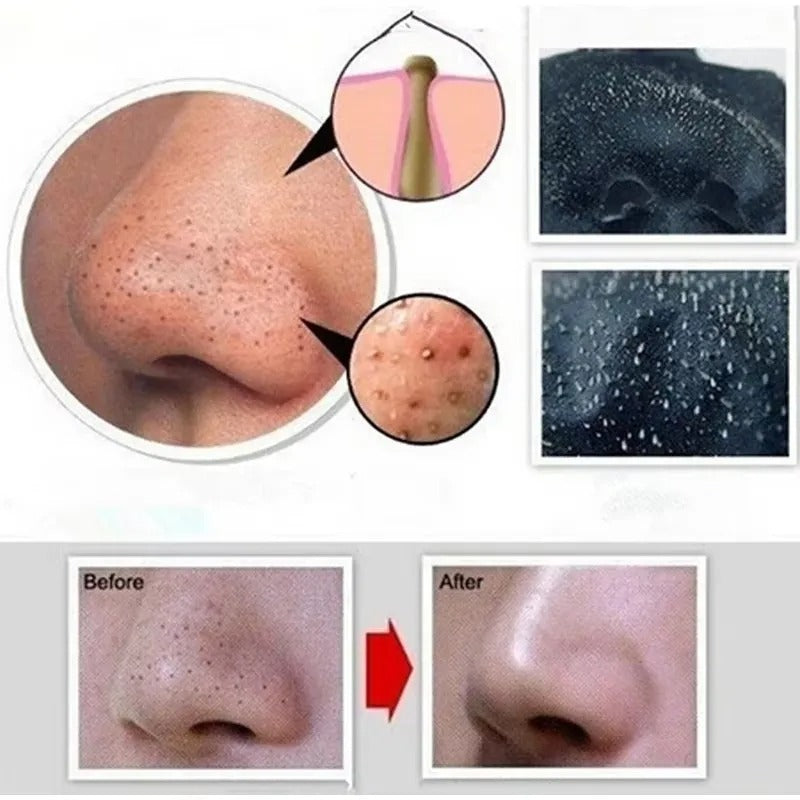 Bamboo Charcoal Blackhead Remover Mask – Pore Cleansing & Acne Care
