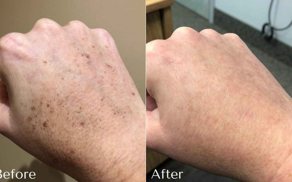 Dark Spot Corrector | 1+1 FREE