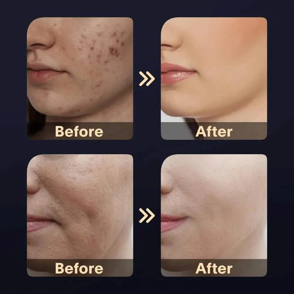 Turbo RF Radio Frequency Skin Tightening Facial Wand